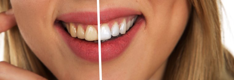 Efekty wybielania zębów